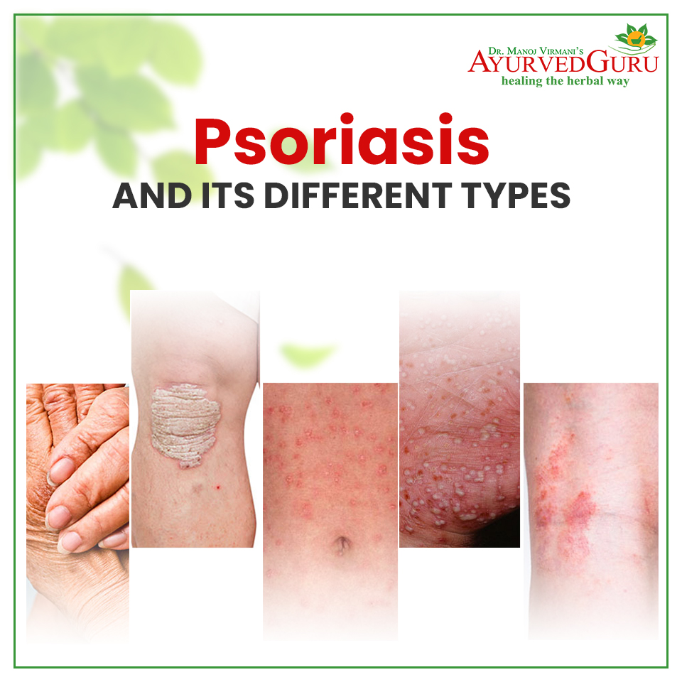 PSORIASIS AND ITS DIFFERENT TYPES