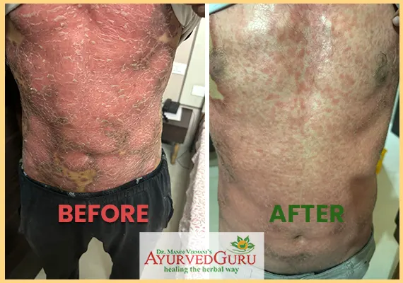 Psoriasis patient healed at Ayurvedguru 4