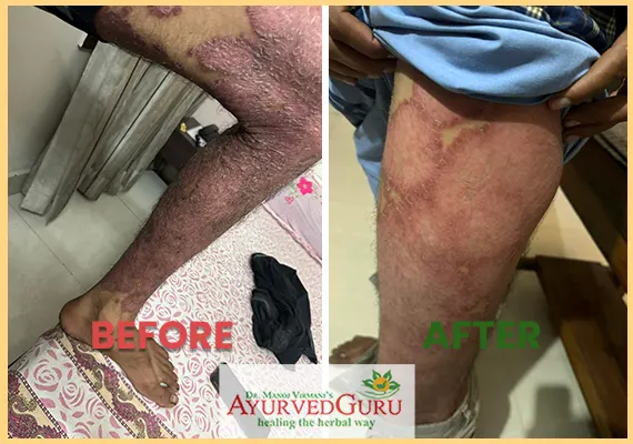 Psoriasis patient healed at Ayurvedguru 2