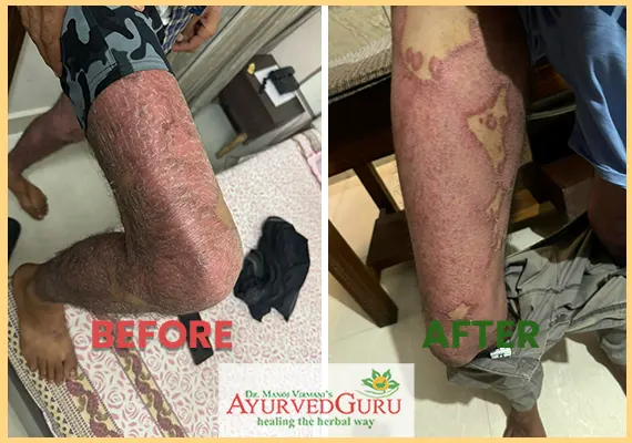 Psoriasis patient healed at Ayurvedguru 3