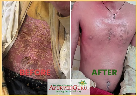 Psoriasis patient healed at Ayurvedguru 1