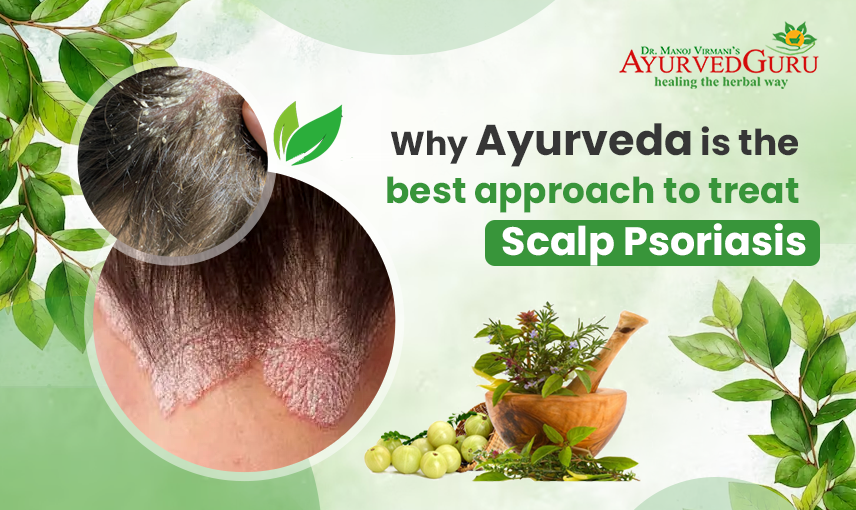 best ayurvedic treatment for scalp psoriasis