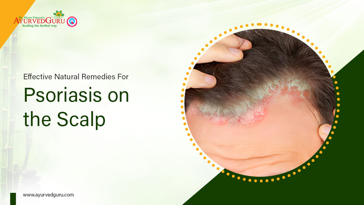  natural remedies for psoriasis on the scalp