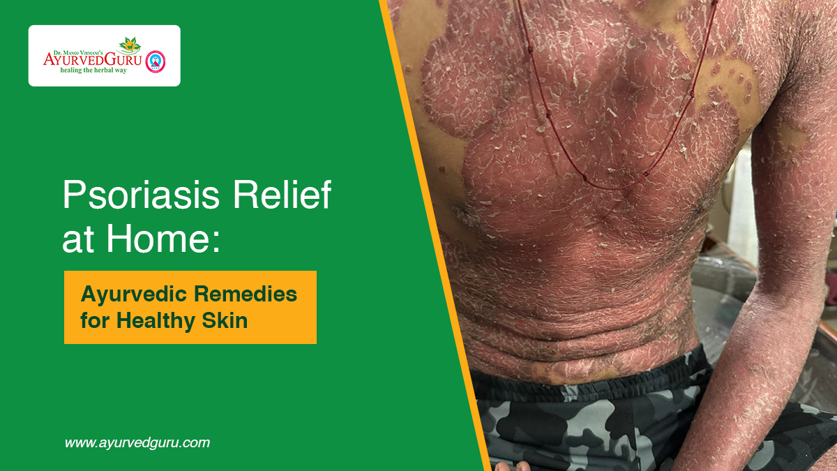  best Ayurvedic medicine for psoriasis