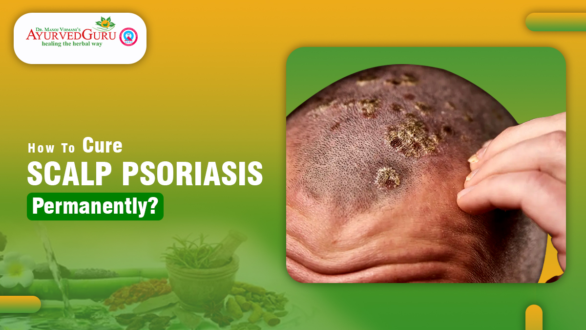 natural remedies for psoriasis on scalp