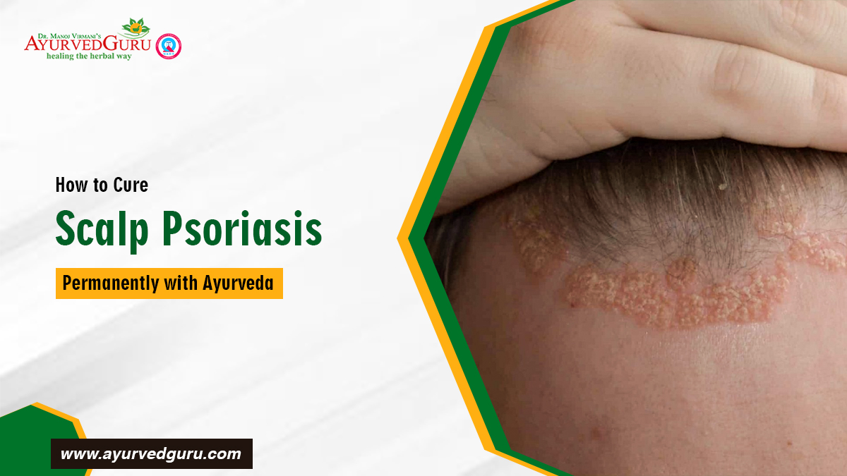 Best Ayurvedic treatment for skin psoriasis