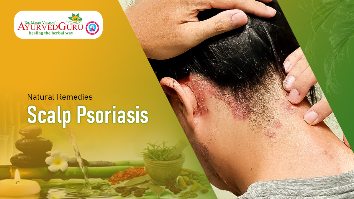 Natural Remedies for Scalp Psoriasis