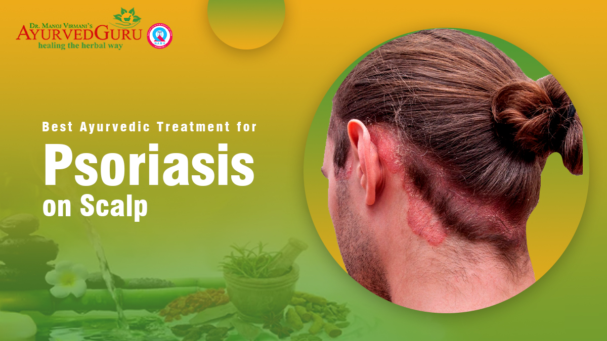 Best Ayurvedic Treatment for Psoriasis on Scalp