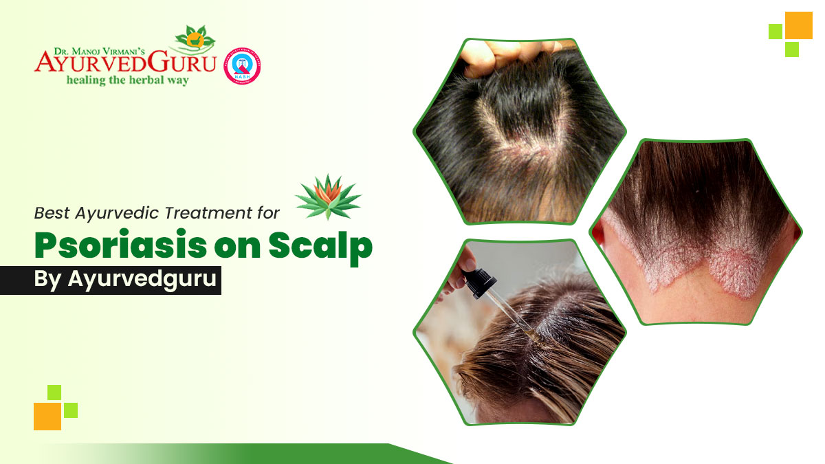 Best Ayurvedic Treatment for Psoriasis on Scalp